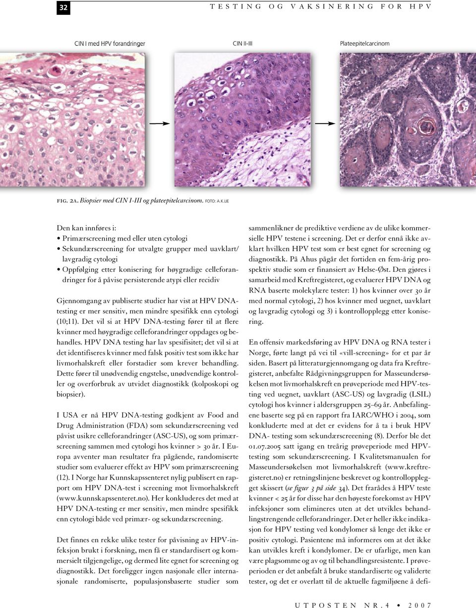 LIE Den kan innføres i: Primærscreening med eller uten cytologi Sekundærscreening for utvalgte grupper med uavklart/ lavgradig cytologi Oppfølging etter konisering for høygradige celleforandringer