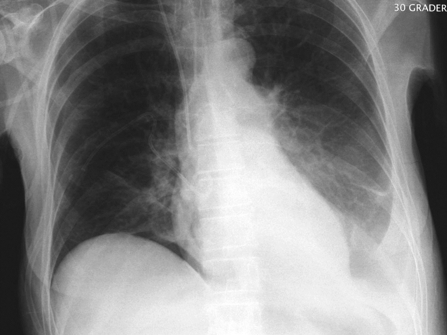 BASAL PNEUMOTHORAX