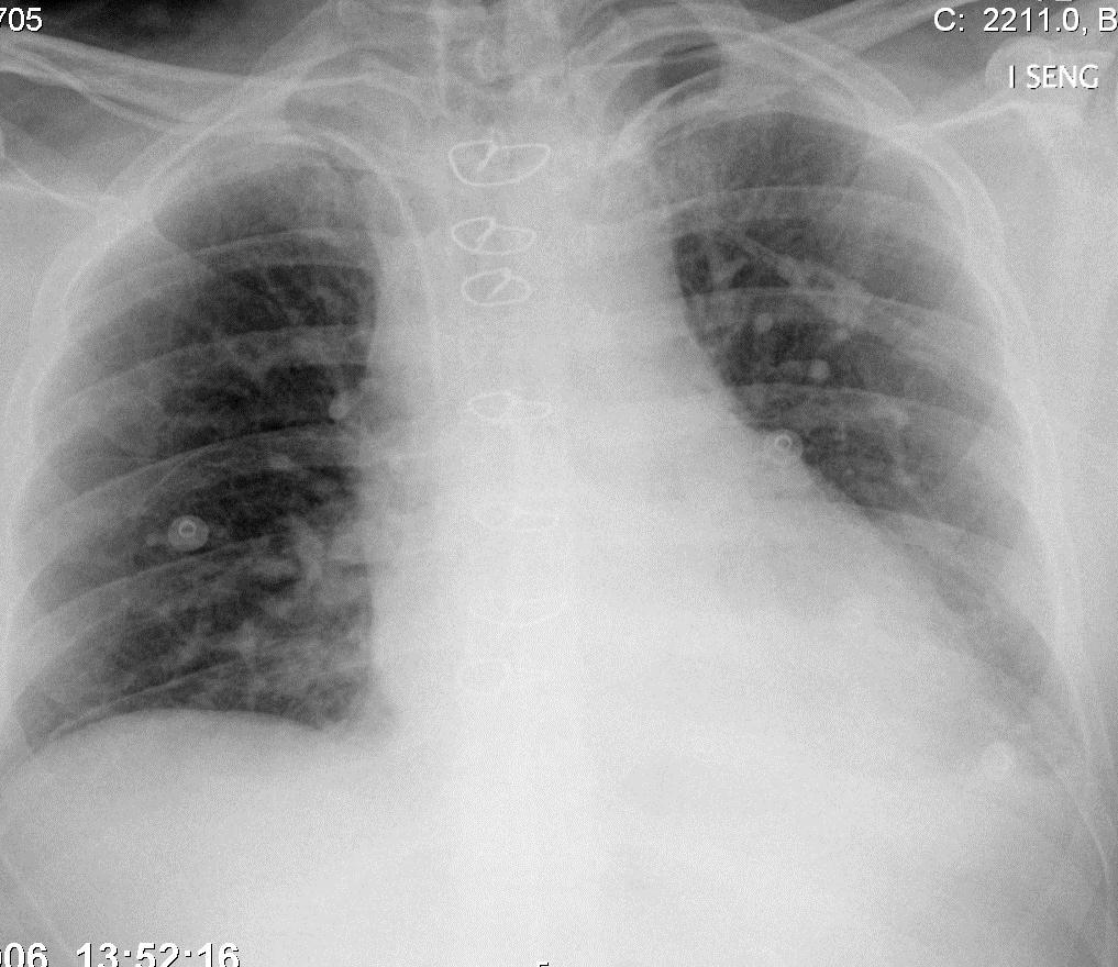 Normalt forløp etter hjerteoperasjon (CABG,