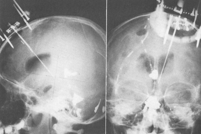 DBS ved PU: Utagering Sano et al 1970 lagde lesjon i bakre del av hypothalamus på 51 personer med «patologisk aggresjon»: EEG Changes.