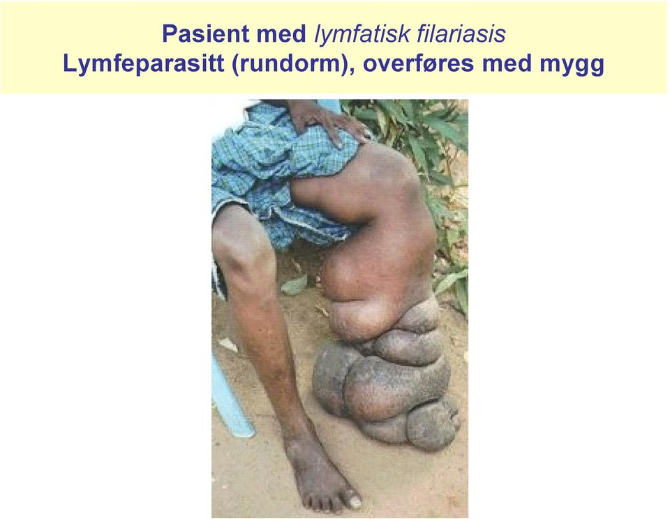 filariasis