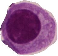 CLL PL Follicular Lymphoma MZL Hairy cell Leukemia Lymphocyte Morphology Hairy cell Leukemia variant LGL-leuk Sezary Syndrome T- PL