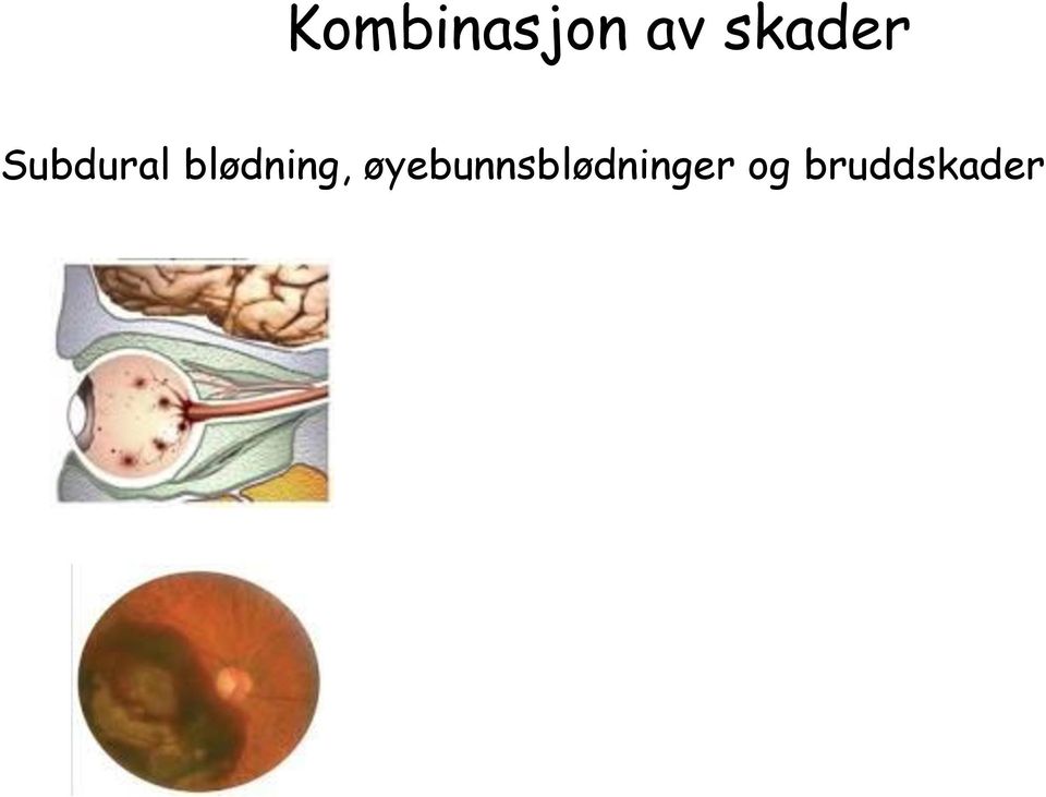 blødning,