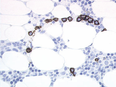 Klonale T-LGL-celler i BM-biopsi Osuji,