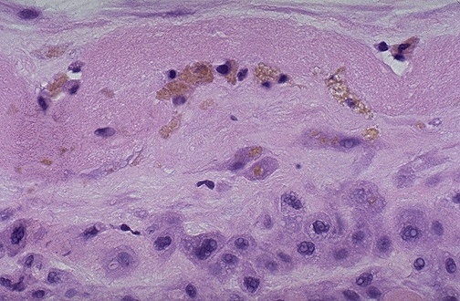 36 5. Histopatologi For å kunne vurdere patologi i placenta histologisk er det nødvendig å ha kliniske opplysninger om gestasjonslengden.