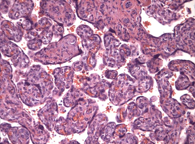 38 Fig. 61: Fibrose i tottestroma Fig. 62: Masson-Trichrom bindevevsfarging 5.1.3 Føtale kartromber En skiller mellom sentrale tromber i stamtottekar og tromber på mikrosirkulasjonsnivå.