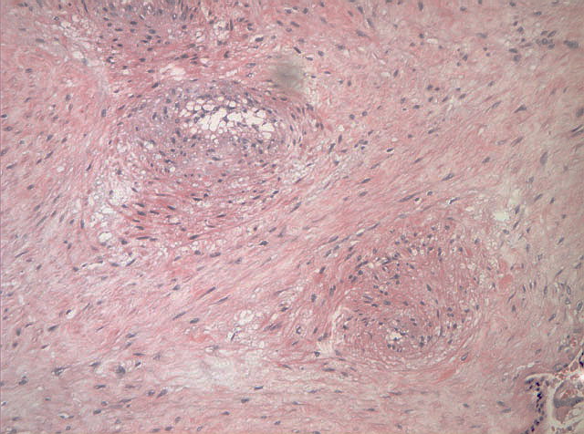 40 Fig. 69: Endangiopathia obliterans i stamtottekar i uke 35 (pil) Fig. 70: Masson-Trichrom bindevevsfarging 5.2.