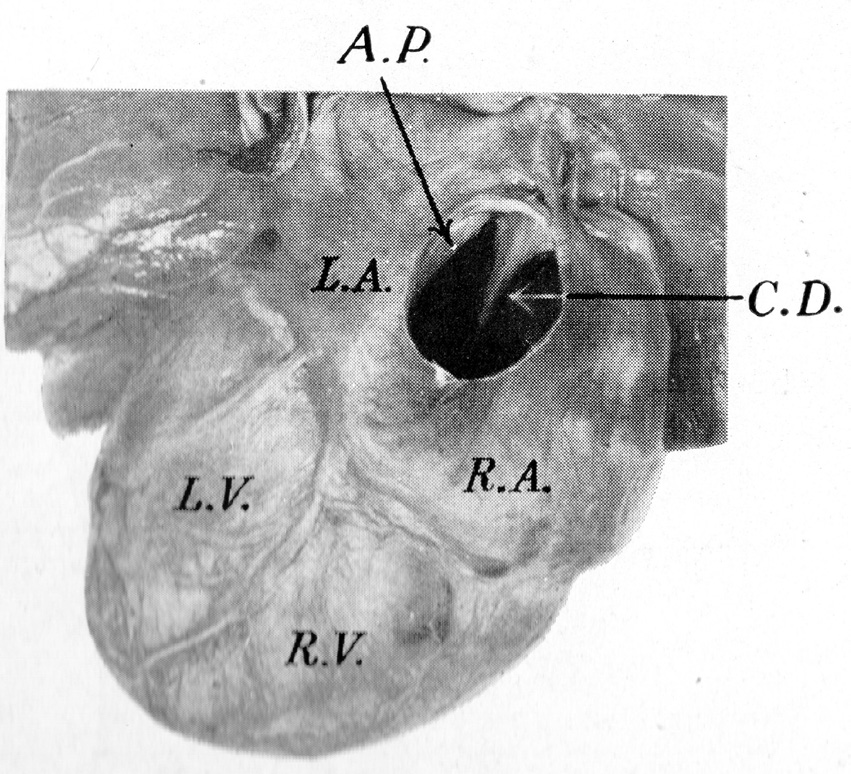 Figur 5: Fosterhjerte nær termin sett nedenfra. Gjennom vena cava inferior (IVC) sees at atrieseptum med foramen ovalekanten crista dividens (C.D.) rager over IVC.