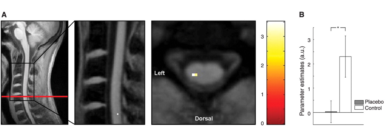 Fig. 1 Pain-related BOLD responses and their reduction by