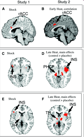 Functional magnetic resonnance imaging of placebo analgesia Wager et al.