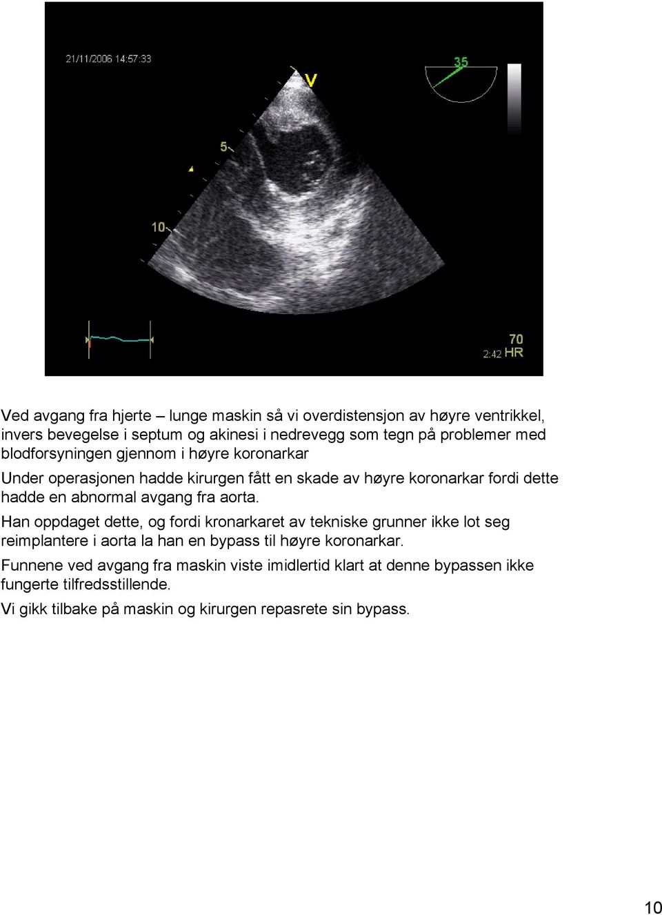 aorta. Han oppdaget dette, og fordi kronarkaret av tekniske grunner ikke lot seg reimplantere i aorta la han en bypass til høyre koronarkar.