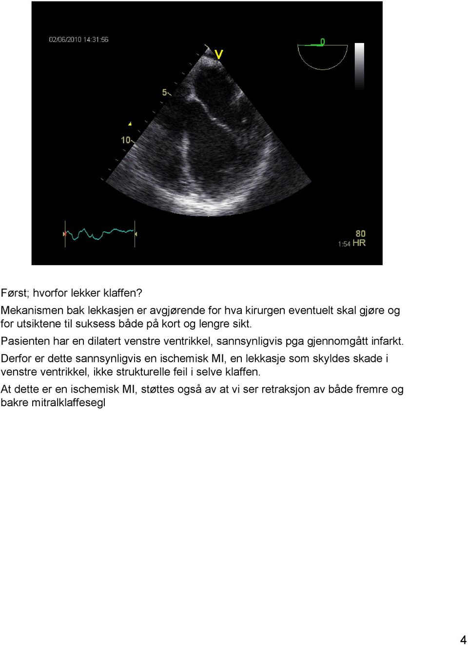 lengre sikt. Pasienten har en dilatert venstre ventrikkel, sannsynligvis pga gjennomgått infarkt.