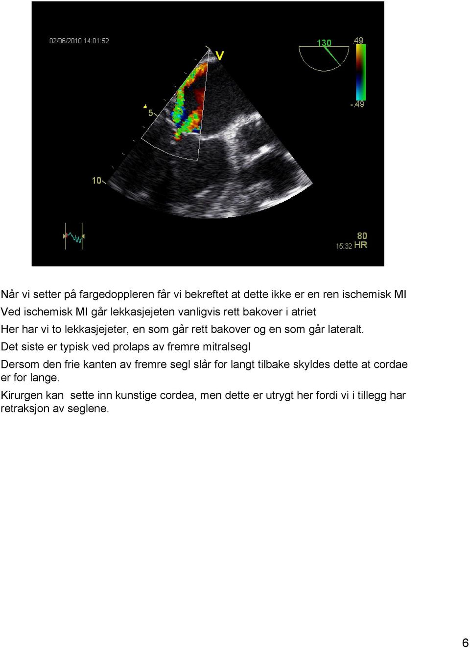 Det siste er typisk ved prolaps av fremre mitralsegl Dersom den frie kanten av fremre segl slår for langt tilbake skyldes