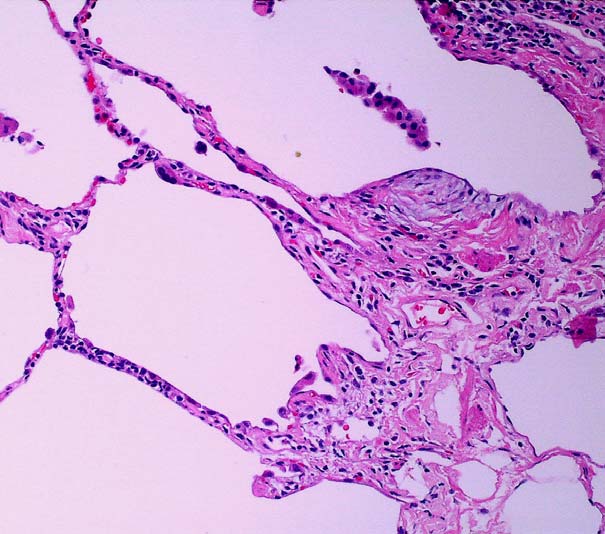 Mønster 2: Fibrose Med temporær heterogen fibrose Usual interstitial