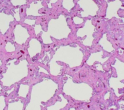 Med diffus fibrose Mønster 2: Fibrose Revmatiske sykdommer Noen pneumokonioser
