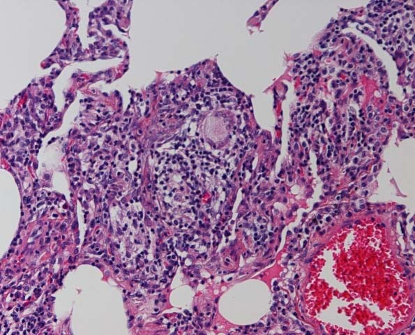 Mønster 3: Interstitiell betennelse Med lymfocytter, plasmaceller, +/- løse granulomer