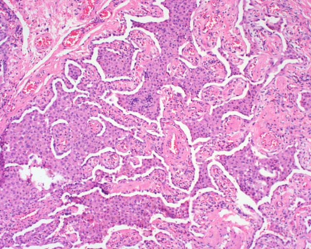 Med makrofager Mønster 4: Alveolar Filling Røykerelaterte