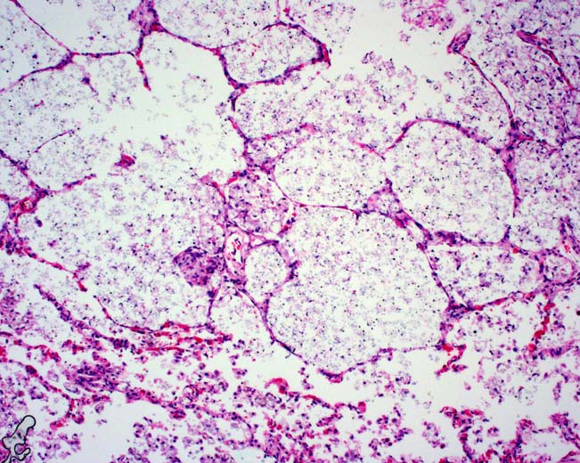 Med mucin Mønster 4: Alveolar Filling Mucostase ved small airway