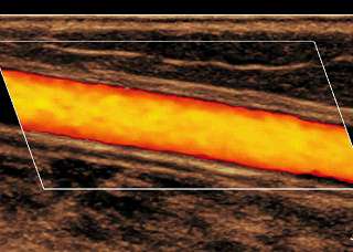 Bakgrunn Indikasjoner Doppler Mapping Modning