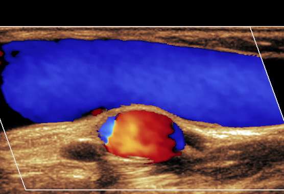 Ultralyd - doppler Undersøkelse av blodstrømmen: