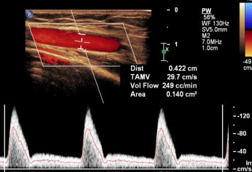 Volumflow The most significant predictor of access failure (Lok C -03) Seriemålinger: - uforandret?