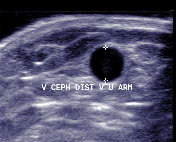 Mapping med ultralyd Pre-operativ undersøkelse Ikke dominant arm (bilat.