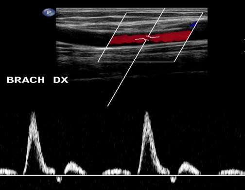 Art. brachialis Diameter