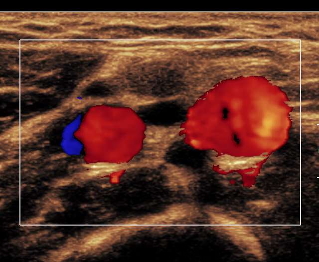 Overarm - arterie Dobbel