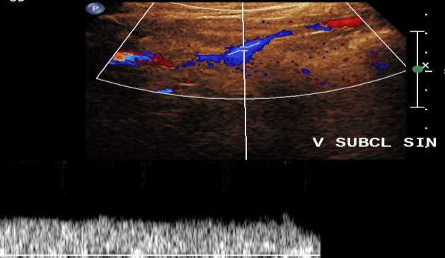 Vena subclavia Patente sentrale