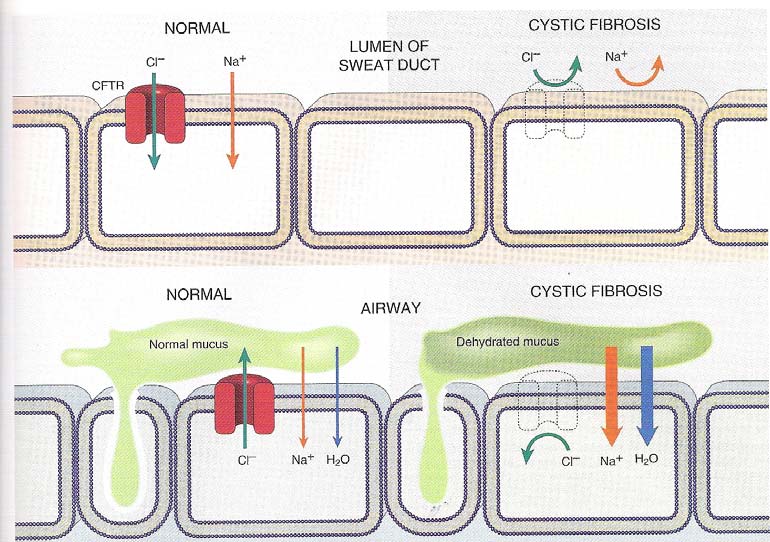 Mekanismen for patologi i luftveiene er annerledes. Normalt luftveisepitel frigjør Cl - ut i lumen ved hjelp av camp-avhengige Cl - -kanaler.