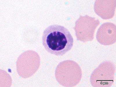 Basofil erytroblast 12-16 μm i diameter Noe tettere kjernestruktur. Blått cytoplasma som mangler korn.