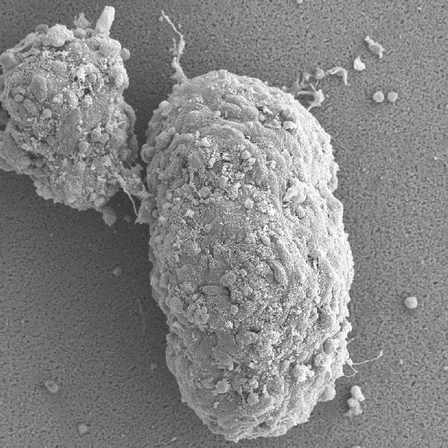 Nyheter Insulinresistente og insulinfølsomme overvektige Insulin sensitiv Insulin resistent De fleste som får diabetes type 2 har gener som rammer insulincellene Mange som får diabetes type 2 har