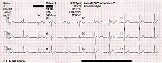 Elektrokardiogram (EKG) http://www.