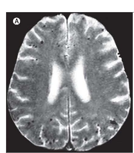 Mulige sykdomsmekanismer Strategiske slag hippocampus frontallappen thalamus basalgangliene Store slag Cerebral amyloid