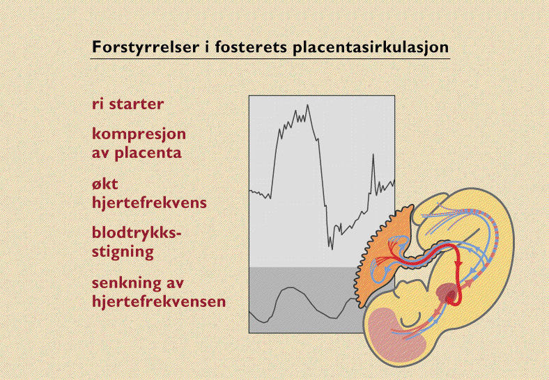 Sinusoidal varabilitet Forekomst 0.3 to 1.7% Ikke perioder med normal CTG ALTID PATOLOGISK CTG Anemi hos fostre!