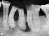 PERIAPIKALE DIAGNOSER K04b Friskt apikalt periodontium K04.4 Akutt apikal periodontitt K04.5 Kronisk apikal periodontitt K04.50 Kronisk apikal periodontitt K04.