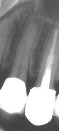 Endodonti er: 1 Forebyggelse av apikal periodontitt: pulpateksjon, pulpaamputasjon, pulpaekstirpasjon 2 Behandling av apikal periodontitt: nekrosebehandling APIKAL PERIODONTITT ER FORÅRSAKET AV