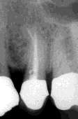 Oversikt over endodontiske prosedyrer Underforing, dentinbehandling Trinnvis ekskavering Indirekte pulpaoverkapning Direkte pulpaoverkapning Pulpotomi, partiell og total Pulpektomi Rotbehandling av
