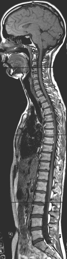 Noen få medisinske uttrykk Cervical 7 virvler Thorakal 12