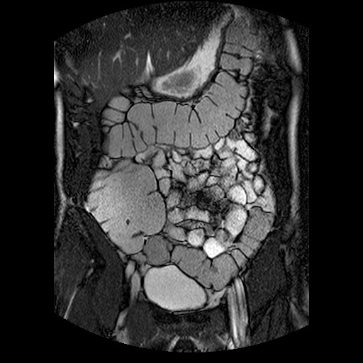 Muligheter Abdomen Fremstilling av