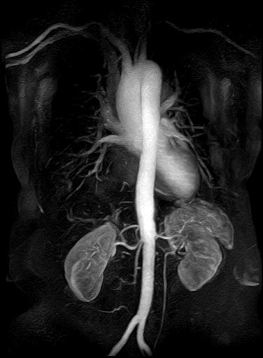 Muligheter Abdomen Fremstilling av aorta