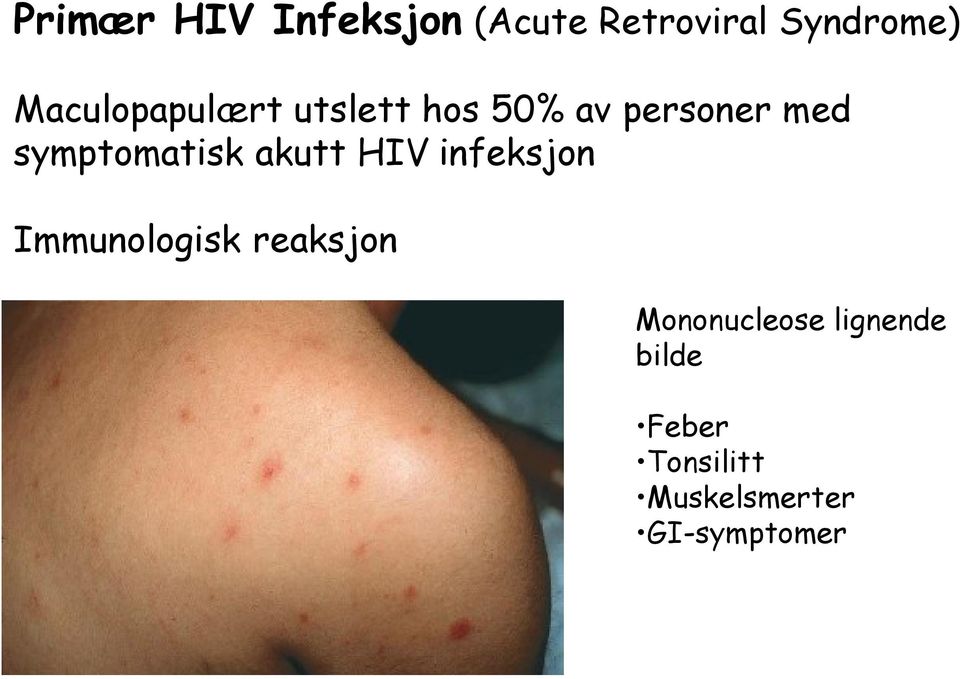 symptomatisk akutt HIV infeksjon Immunologisk reaksjon