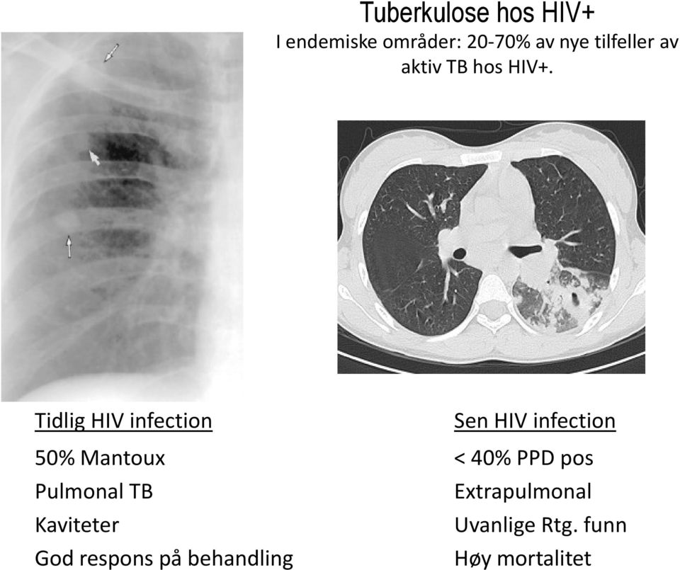 Tidlig HIV infection Sen HIV infection 50% Mantoux < 40% PPD
