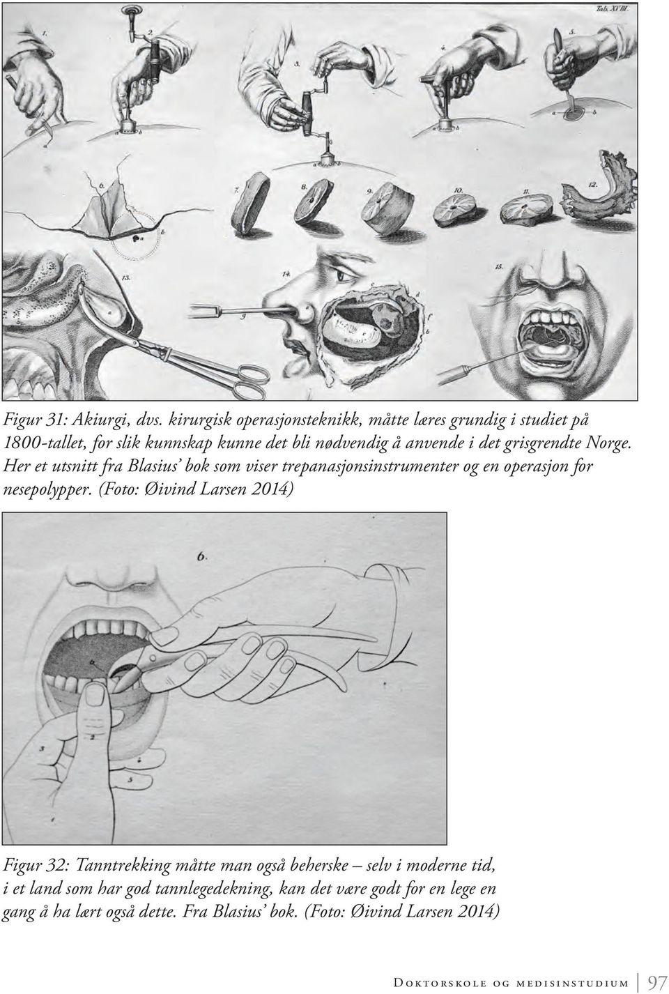 grisgrendte Norge. Her et utsnitt fra Blasius bok som viser trepanasjonsinstrumenter og en operasjon for nesepolypper.