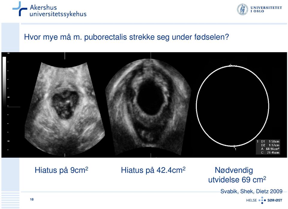 fødselen?