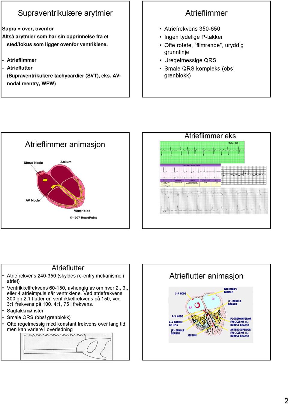 AVnodal reentry, WPW) Atrieflimmer Atriefrekvens 350-650 Ingen tydelige P-takker Ofte rotete, flimrende, uryddig grunnlinje Uregelmessige QRS Smale QRS kompleks (obs!