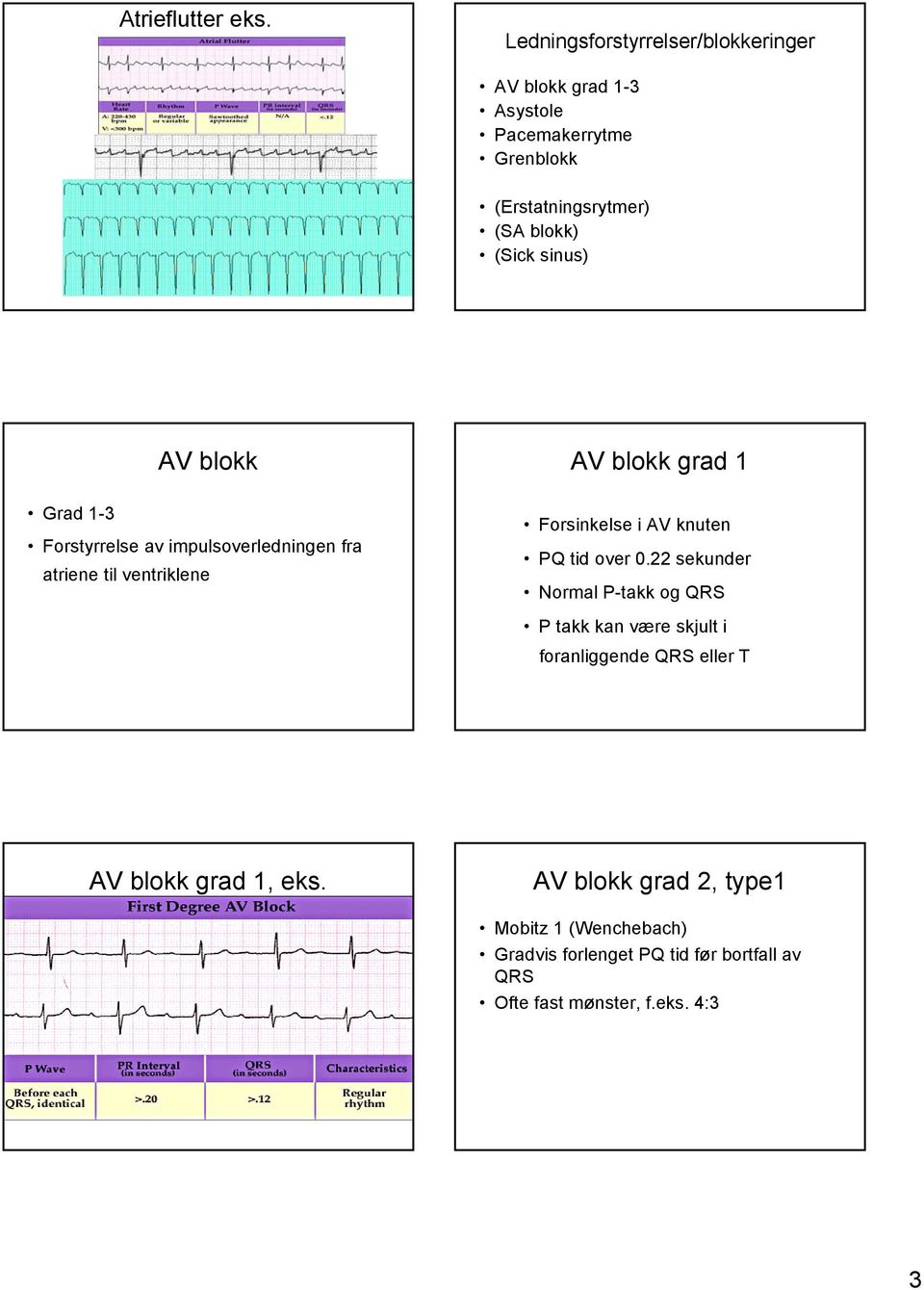 sinus) AV blokk Grad 1-3 Forstyrrelse av impulsoverledningen fra atriene til ventriklene AV blokk grad 1 Forsinkelse i AV