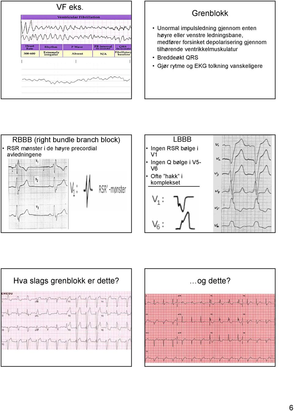 depolarisering gjennom tilhørende ventrikkelmuskulatur Breddeøkt QRS Gjør rytme og EKG tolkning