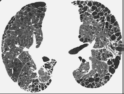 HRCT ved IPF Positive predictive value 90-100% UIP pattern Retikulæreforandringer subpleuraltog basalt Honeycombingmed eller