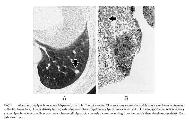 Pulmonale lymfeknuter antas å være hyperplastiske lymfeknuter relatert til antigen stimuli etter bl.a. inhalasjon av irriterende stoffer.